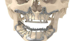 Tipos de Implante Dentário
